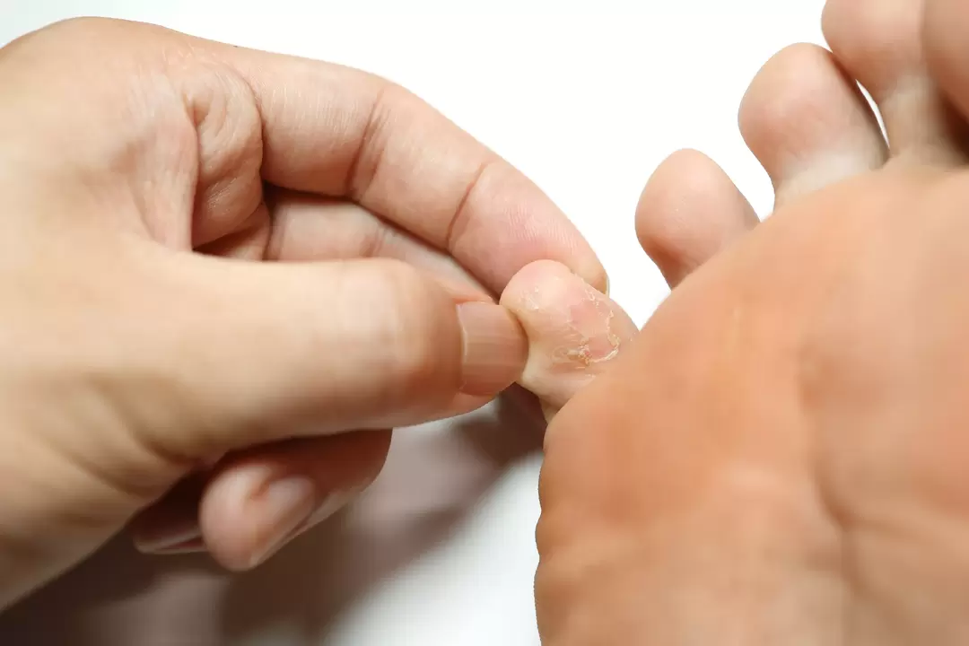 Pilze auf den Fingern und seine Behandlung mit ZXCVBNQWERT -Creme mit Creme