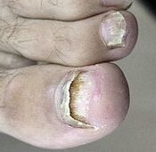Nagelpilz gestartet