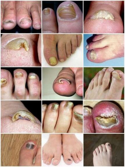 Pilzinfektion der Nagelplatte