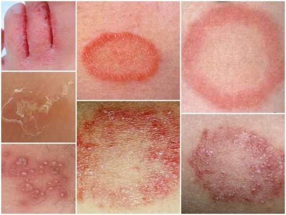 Ringwurm der Haut der Beine